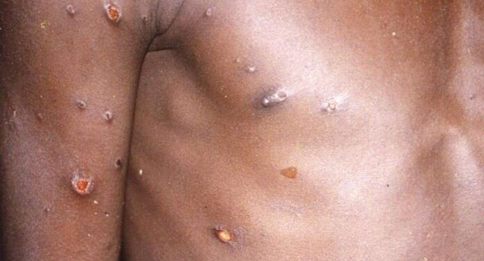 Santé : Des cas de variole du singe détectés dans le Sud-Ouest du Cameroun