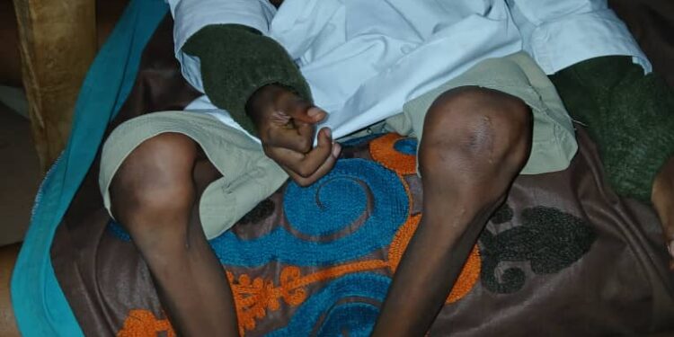 Guinée : Alpha Oumar Sow se bat pour vivre après avoir avalé de la soude