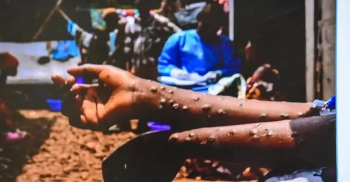 Incendie de l&rsquo;entrepôt du PEV/Lutte contre le Mpox : Les acteurs du système de Santé en concertation