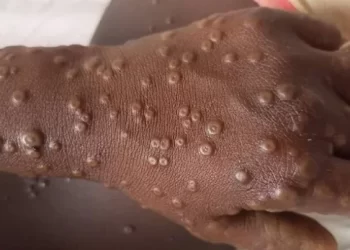 Conakry/Matam : Une assise communautaire autour de la riposte contre la variole de Singe