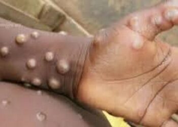 Situation sanitaire liée à la MPOX en Guinée : 28 nouveaux cas confirmés