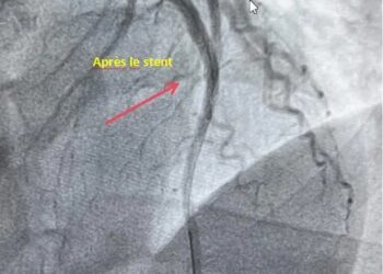 Hôpital de l’Amitié Sino-Guinéenne : Intervention coronarographique d’urgence réalisée au sein de l’établissement