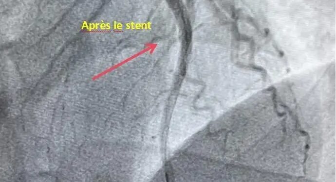 Hôpital de l’Amitié Sino-Guinéenne : Intervention coronarographique d’urgence réalisée au sein de l’établissement