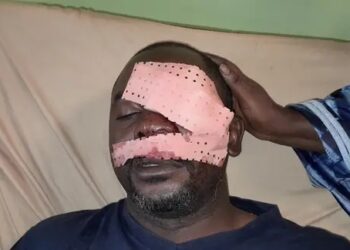 Conakry : Un journaliste sportif victime d&rsquo;une agression barbare perd son œil gauche