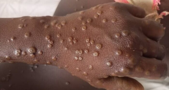 Prévention de la Mpox en Guinée : L’ACGP sensibilisé par l’ANSS