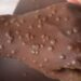Prévention de la Mpox en Guinée : L’ACGP sensibilisé par l’ANSS