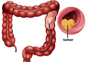 Contre le cancer colorectal en Guinée : Le vrai danger, c’est le silence