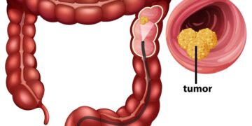 Contre le cancer colorectal en Guinée : Le vrai danger, c’est le silence