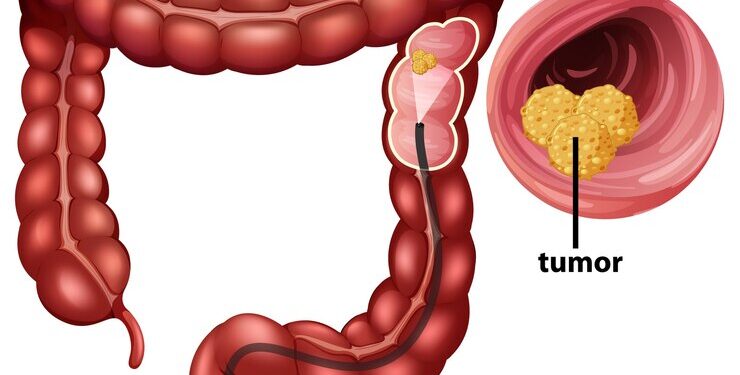 Contre le cancer colorectal en Guinée : Le vrai danger, c’est le silence