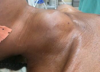 🇬🇳Santé – Quand un simple gonflement devient une urgence médicale