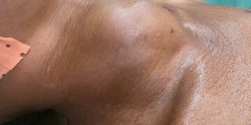 🇬🇳Santé – Quand un simple gonflement devient une urgence médicale