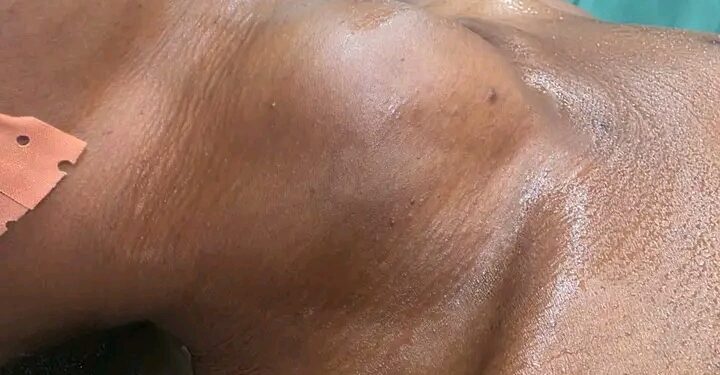 🇬🇳Santé – Quand un simple gonflement devient une urgence médicale