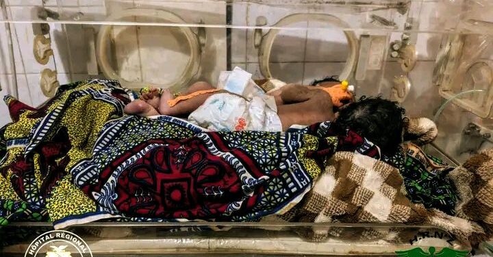 🇬🇳Naissance de bébés siamois à N’Zérékoré