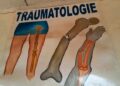 🇬🇳Kankan : Le service de traumatologie et d’orthopédie réduit les évacuations sanitaires