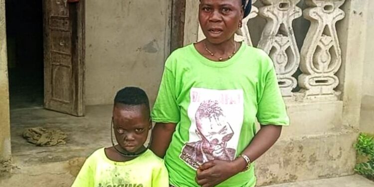🇬🇳Santé publique : Un appel à l’aide pour le petit Pépé Kpoghomou, victime de graves brûlures à Yomou