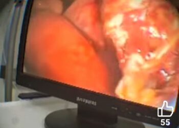 🇬🇳Hôpital de l’Amitié Sino‑Guinéenne : La chirurgie cœlioscopique au service des patients