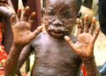🇬🇳Hôpital Régional de Mamou : Le personnel formé aux bonnes pratiques de prévention de la mpox…