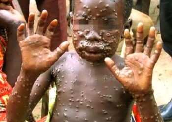 🇬🇳Hôpital Régional de Mamou : Le personnel formé aux bonnes pratiques de prévention de la mpox…