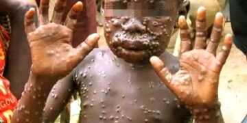 🇬🇳Hôpital Régional de Mamou : Le personnel formé aux bonnes pratiques de prévention de la mpox…