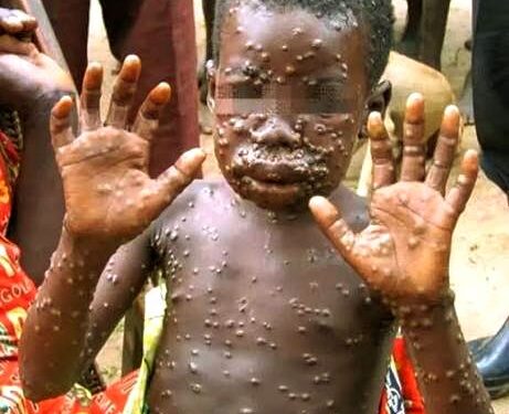 🇬🇳Hôpital Régional de Mamou : Le personnel formé aux bonnes pratiques de prévention de la mpox…