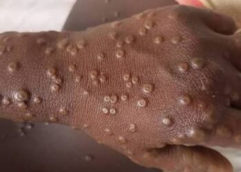 🇬🇳Kindia : Clôture de la Revue Intra-Action dédiée à la riposte contre la mpox