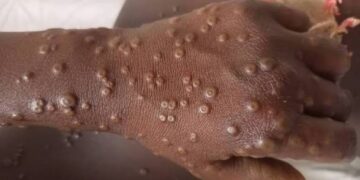 🇬🇳Kindia : Clôture de la Revue Intra-Action dédiée à la riposte contre la mpox