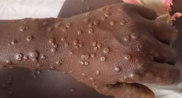 🇬🇳Kindia : Clôture de la Revue Intra-Action dédiée à la riposte contre la mpox