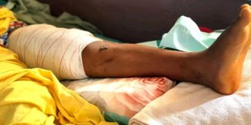 🇬🇳Kankan : L’Orthopédie-Traumatologie au service des soins spécialisés